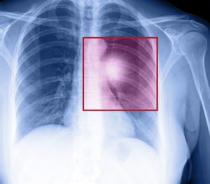 lung x-ray